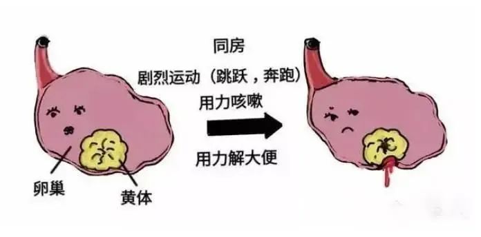腹痛运动后右下腹痛_腹痛运动后就减轻_运动后腹痛